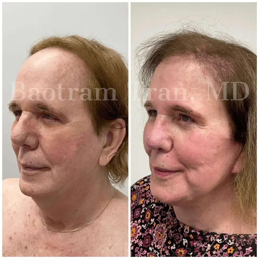 Dr. Tran Cosmetics facelift result — Aventura, FL