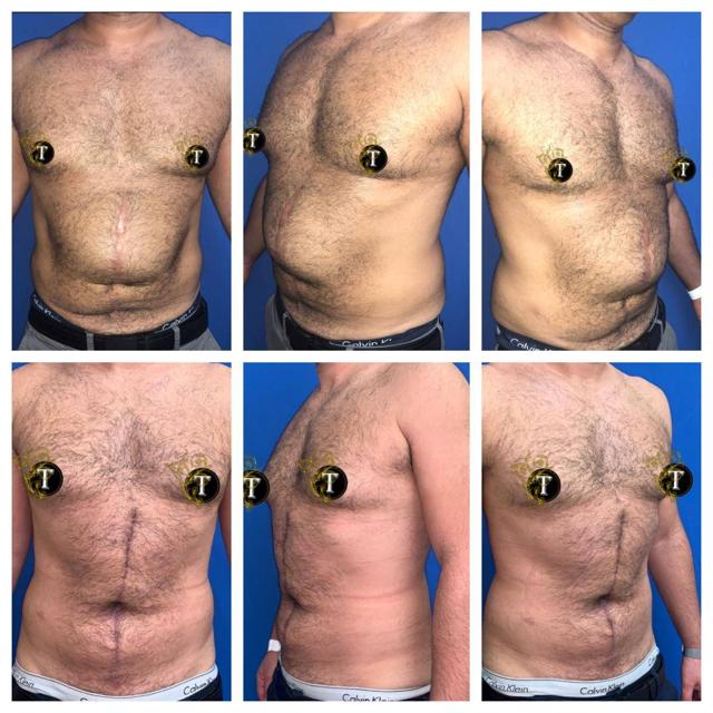 Tummy Tuck result at Dr. Tran Cosmetics in Aventura, FL