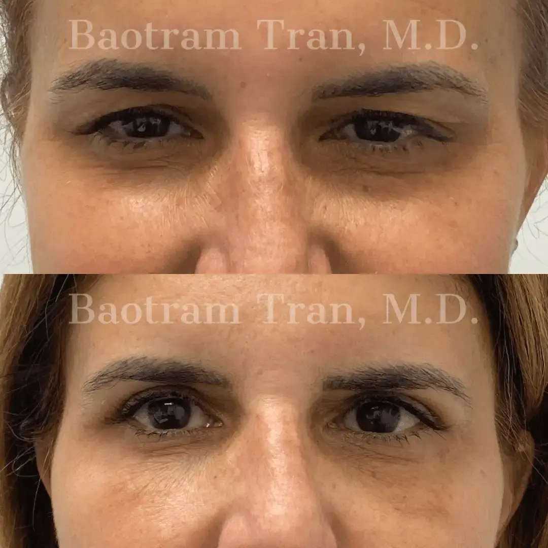 Dr. Tran Cosmetics blepharoplasty result — Aventura, FL