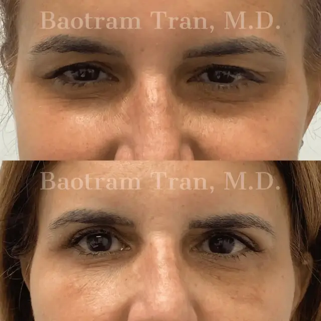 Blepharoplasty result at Dr. Tran Cosmetics in Aventura, FL