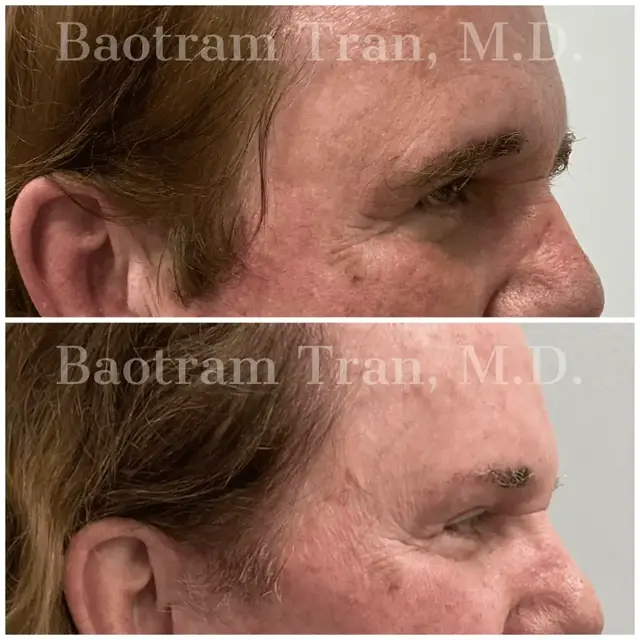 Brow Lift result at Dr. Tran Cosmetics in Aventura, FL