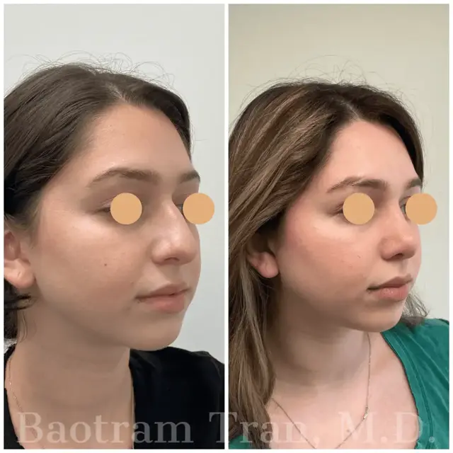 Rhinoplasty result at Dr. Tran Cosmetics in Aventura, FL