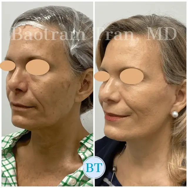 Facelift result at Dr. Tran Cosmetics in Aventura, FL