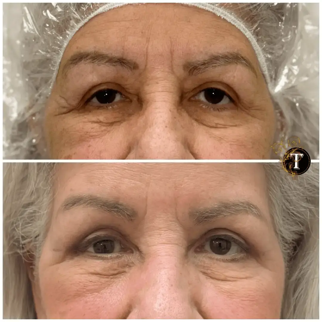 Dr. Tran Cosmetics blepharoplasty result — Aventura, FL