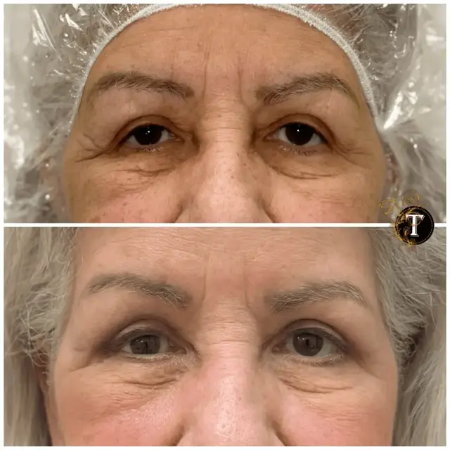 Blepharoplasty result at Dr. Tran Cosmetics in Aventura, FL