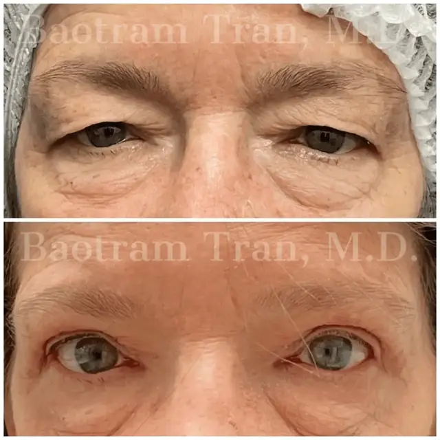 Blepharoplasty result at Dr. Tran Cosmetics in Aventura, FL