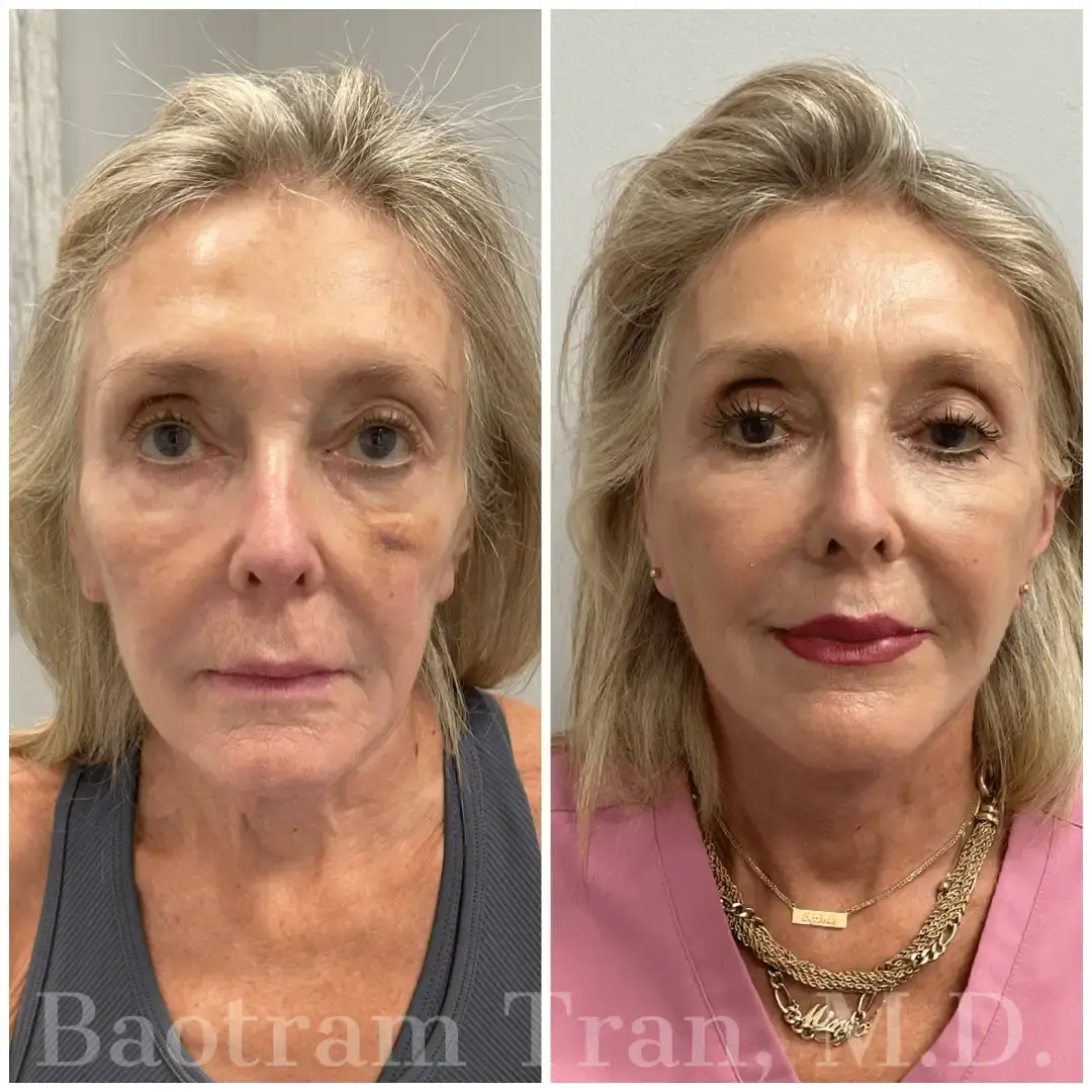 Dr. Tran Cosmetics facelift result — Aventura, FL