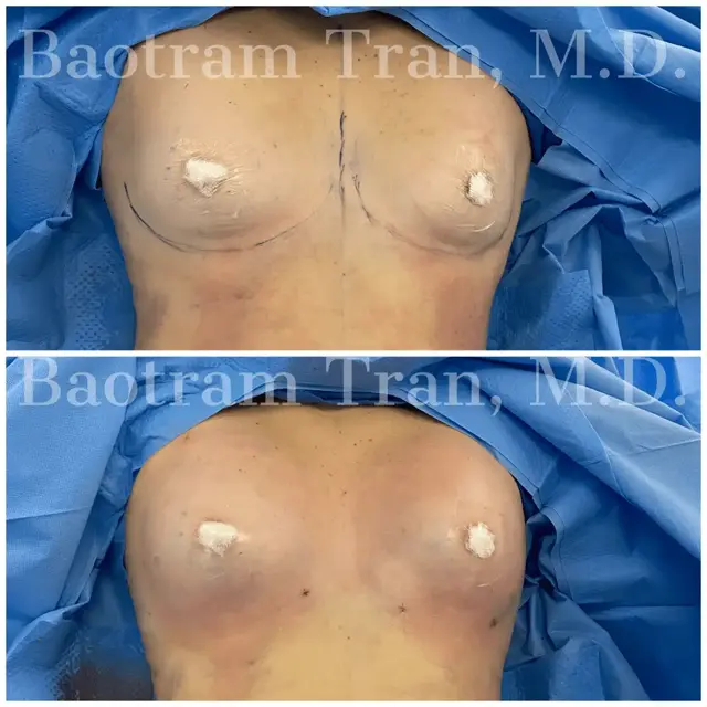 Fat Transfer result at Dr. Tran Cosmetics in Aventura, FL