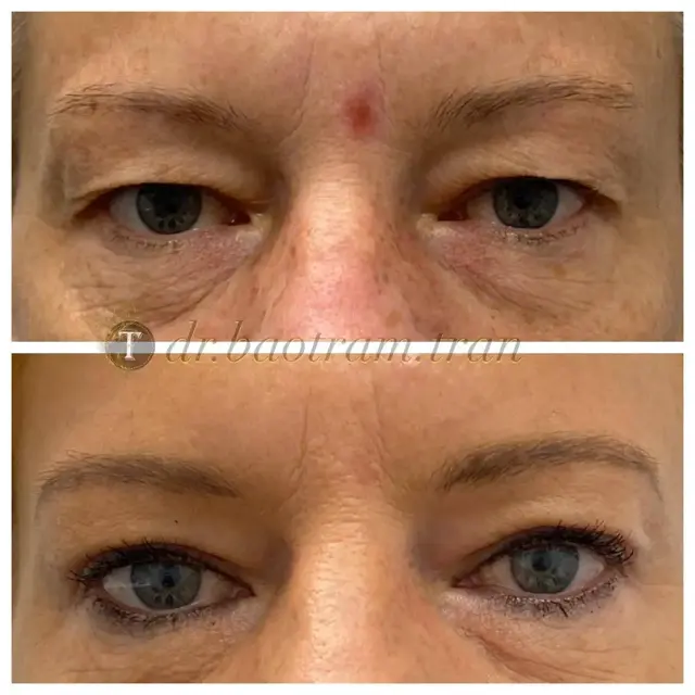 Blepharoplasty result at Dr. Tran Cosmetics in Aventura, FL