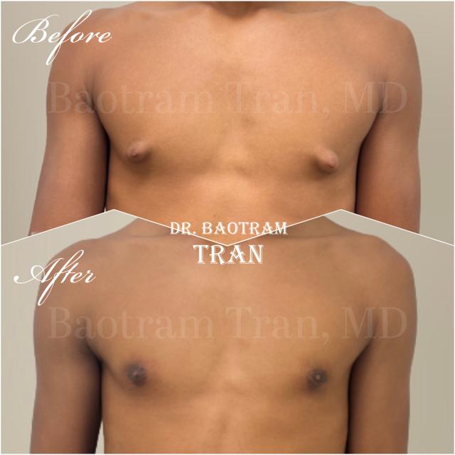 Gynecomastia Surgery result at Dr. Tran Cosmetics in Aventura, FL