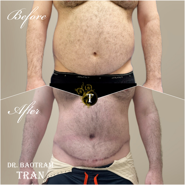 Tummy Tuck result at Dr. Tran Cosmetics in Aventura, FL