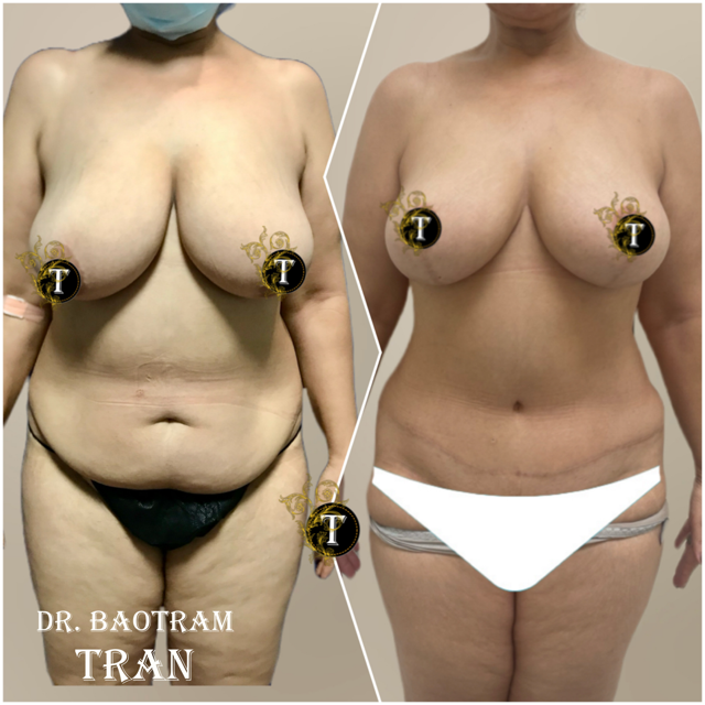 Mommy Makeover result at Dr. Tran Cosmetics in Aventura, FL