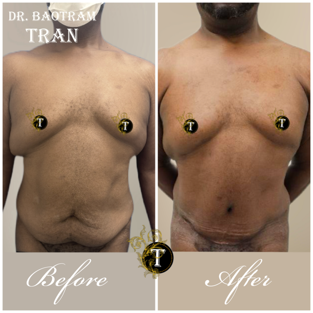 Tummy Tuck result at Dr. Tran Cosmetics in Aventura, FL