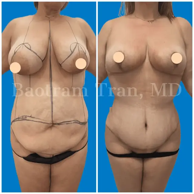 Tummy Tuck result at Dr. Tran Cosmetics in Aventura, FL
