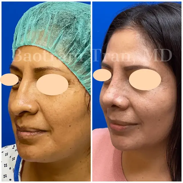 Rhinoplasty result at Dr. Tran Cosmetics in Aventura, FL