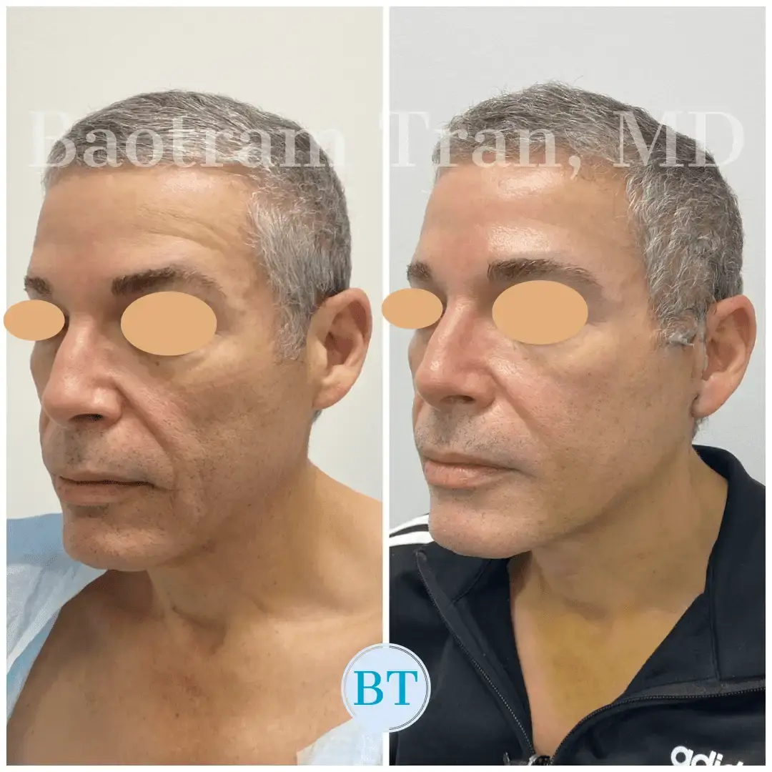 Dr. Tran Cosmetics facelift result — Aventura, FL