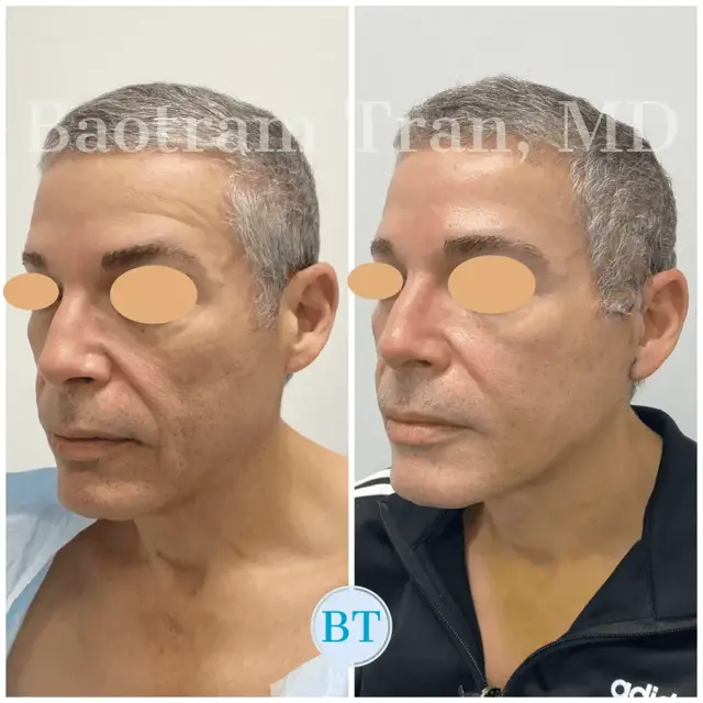 Facelift result at Dr. Tran Cosmetics in Aventura, FL