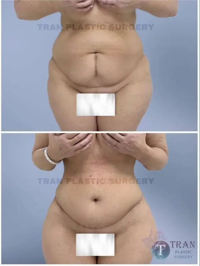 Tummy Tuck result at Dr. Tran Cosmetics in Aventura, FL