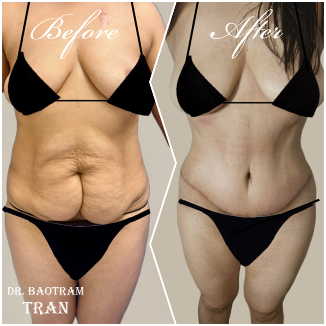 Mini Tummy Tuck result at Dr. Tran Cosmetics in Aventura, FL