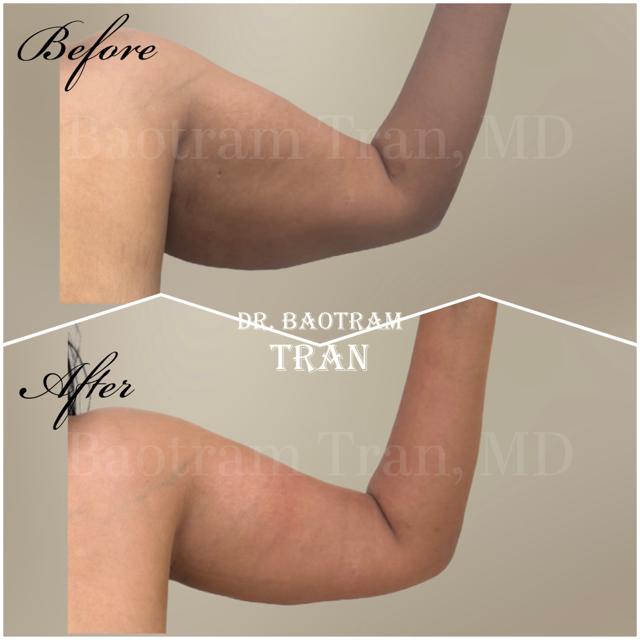 Arm Lift result at Dr. Tran Cosmetics in Aventura, FL