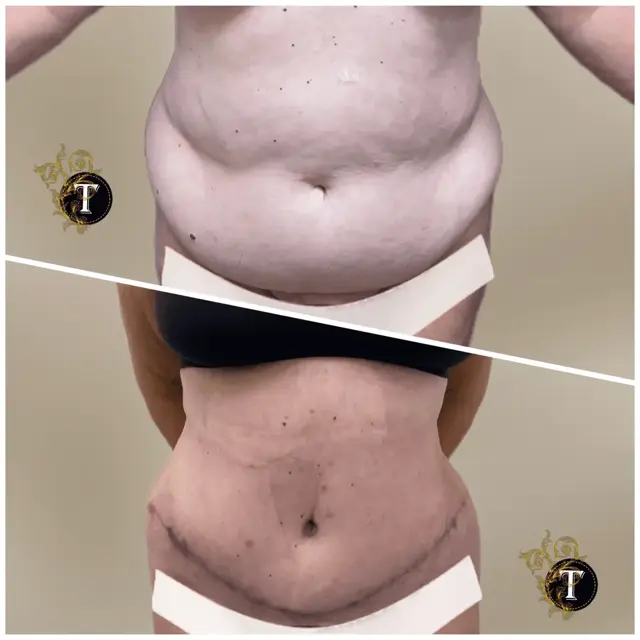 Tummy Tuck result at Dr. Tran Cosmetics in Aventura, FL
