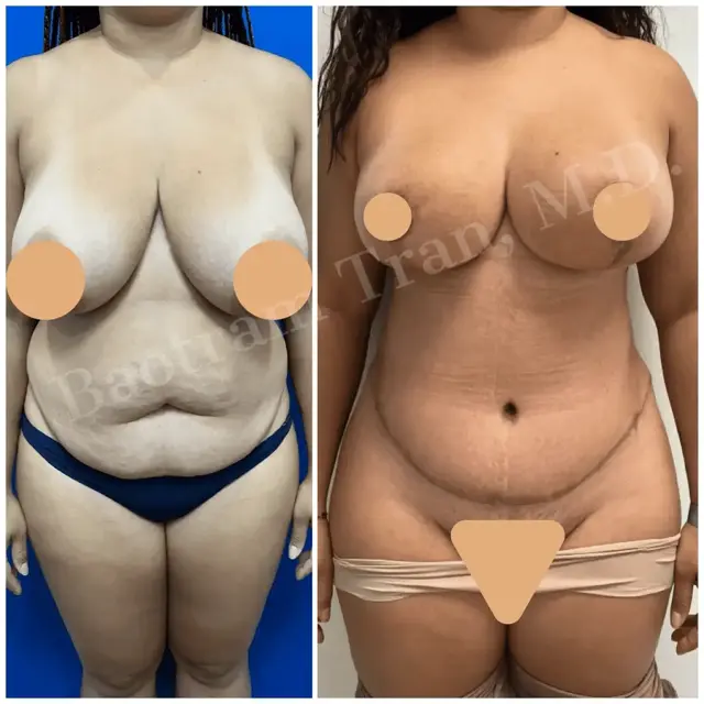 Mommy Makeover result at Dr. Tran Cosmetics in Aventura, FL