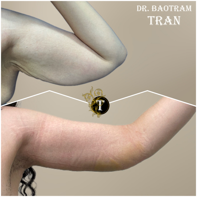 Arm Lift result at Dr. Tran Cosmetics in Aventura, FL