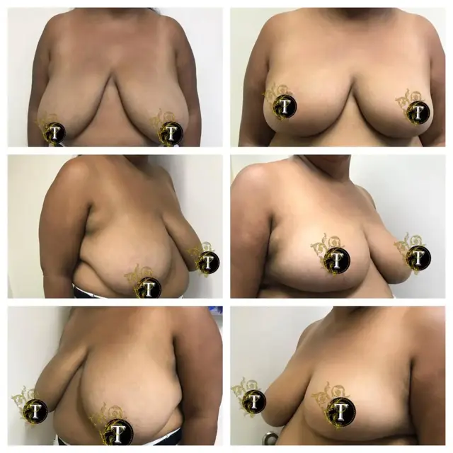 Breast Reduction result at Dr. Tran Cosmetics in Aventura, FL