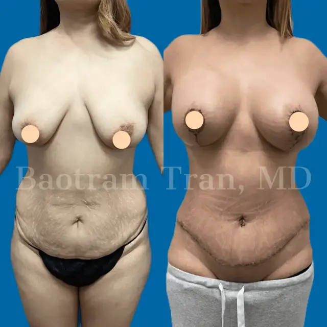 Tummy Tuck result at Dr. Tran Cosmetics in Aventura, FL