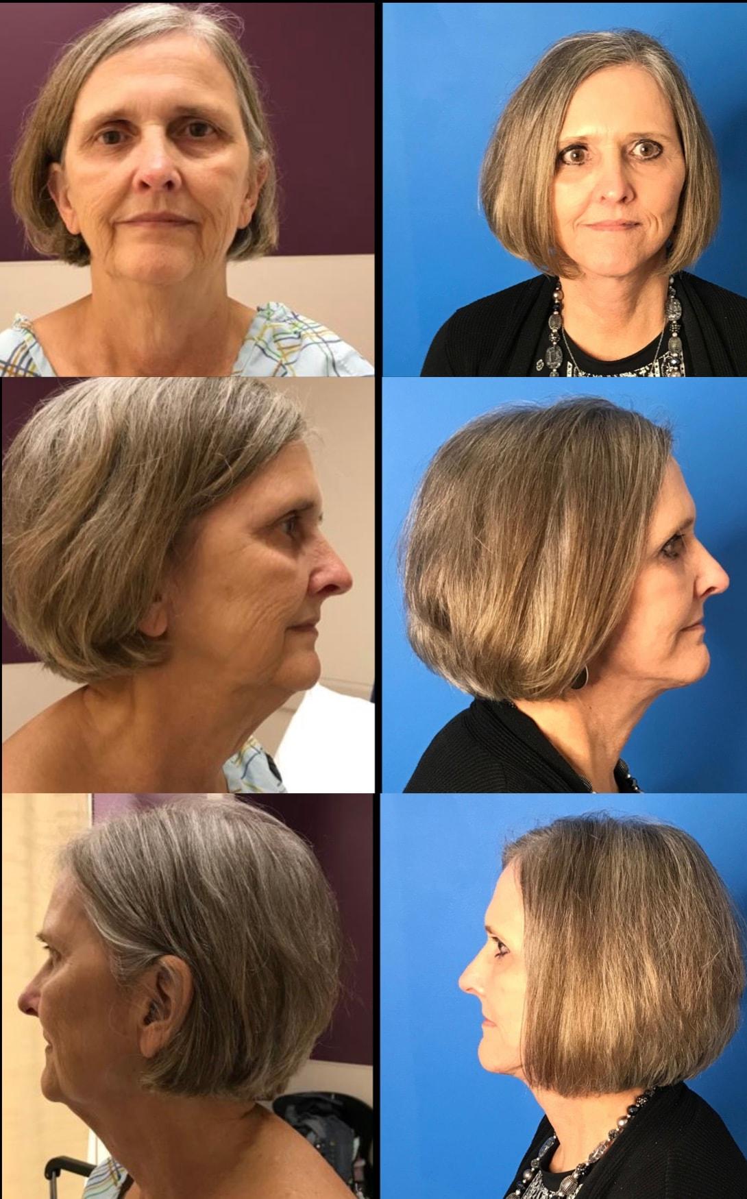 Stanwix Plastic Surgery facelift result — Richmond, VA