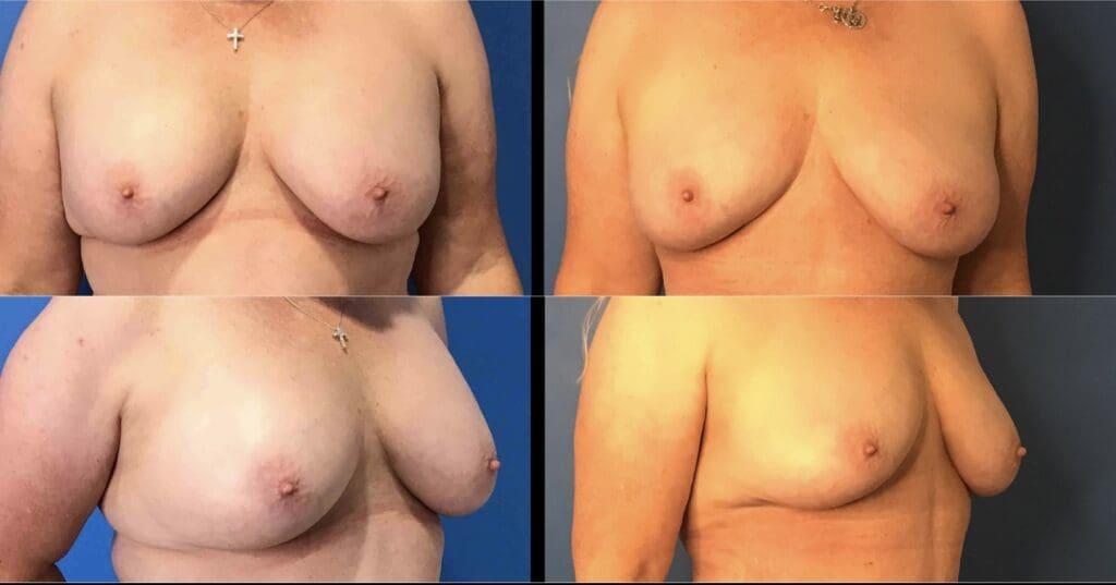 Stanwix Plastic Surgery breast lift result — Henrico, VA