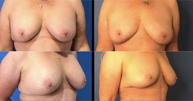 Breast Lift result at Stanwix Plastic Surgery in Henrico, VA