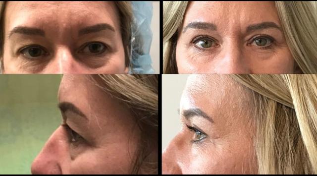 Blepharoplasty result at Stanwix Plastic Surgery in Richmond, VA