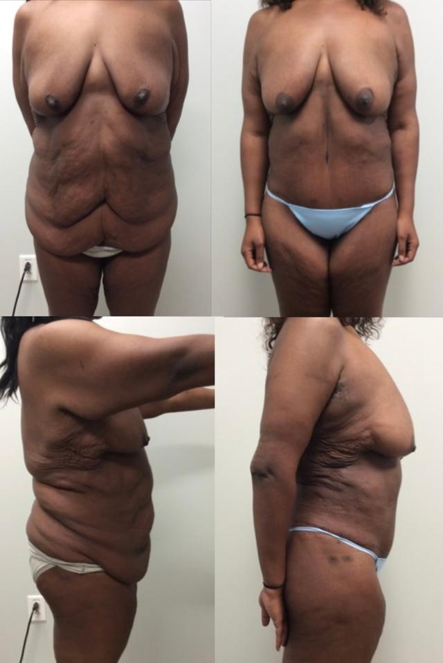 Arm Lift result at Stanwix Plastic Surgery in Richmond, VA
