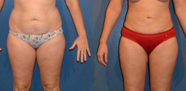 Liposuction result at Stanwix Plastic Surgery in Richmond, VA