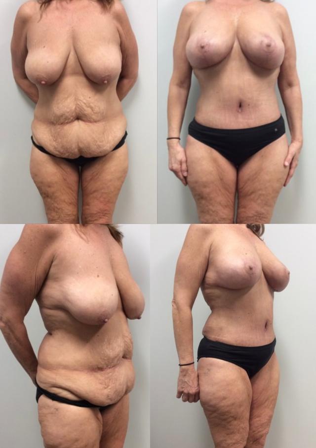 Mommy Makeover result at Stanwix Plastic Surgery in Richmond, VA