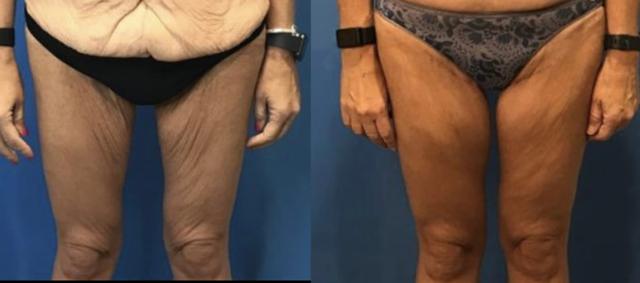 CoolSculpting result at Stanwix Plastic Surgery in Richmond, VA