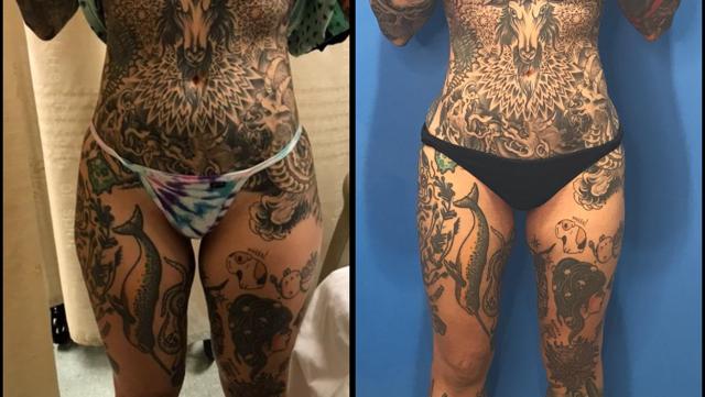 Liposuction result at Stanwix Plastic Surgery in Richmond, VA