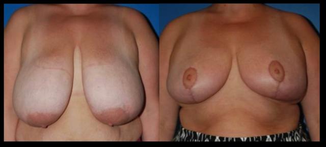 Breast Reduction result at Stanwix Plastic Surgery in Richmond, VA