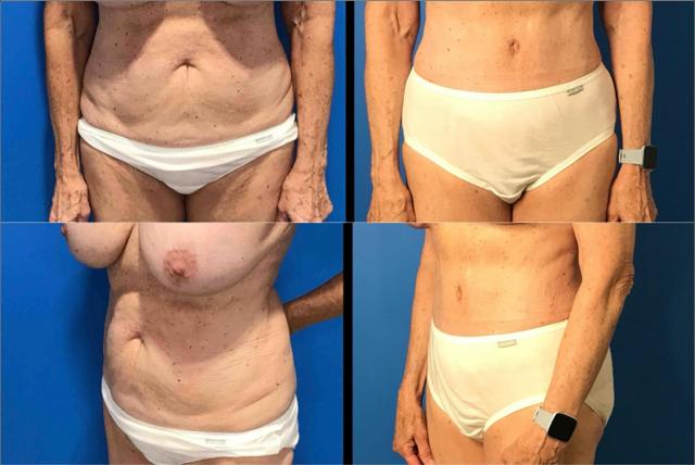 Mini Tummy Tuck result at Stanwix Plastic Surgery in Richmond, VA