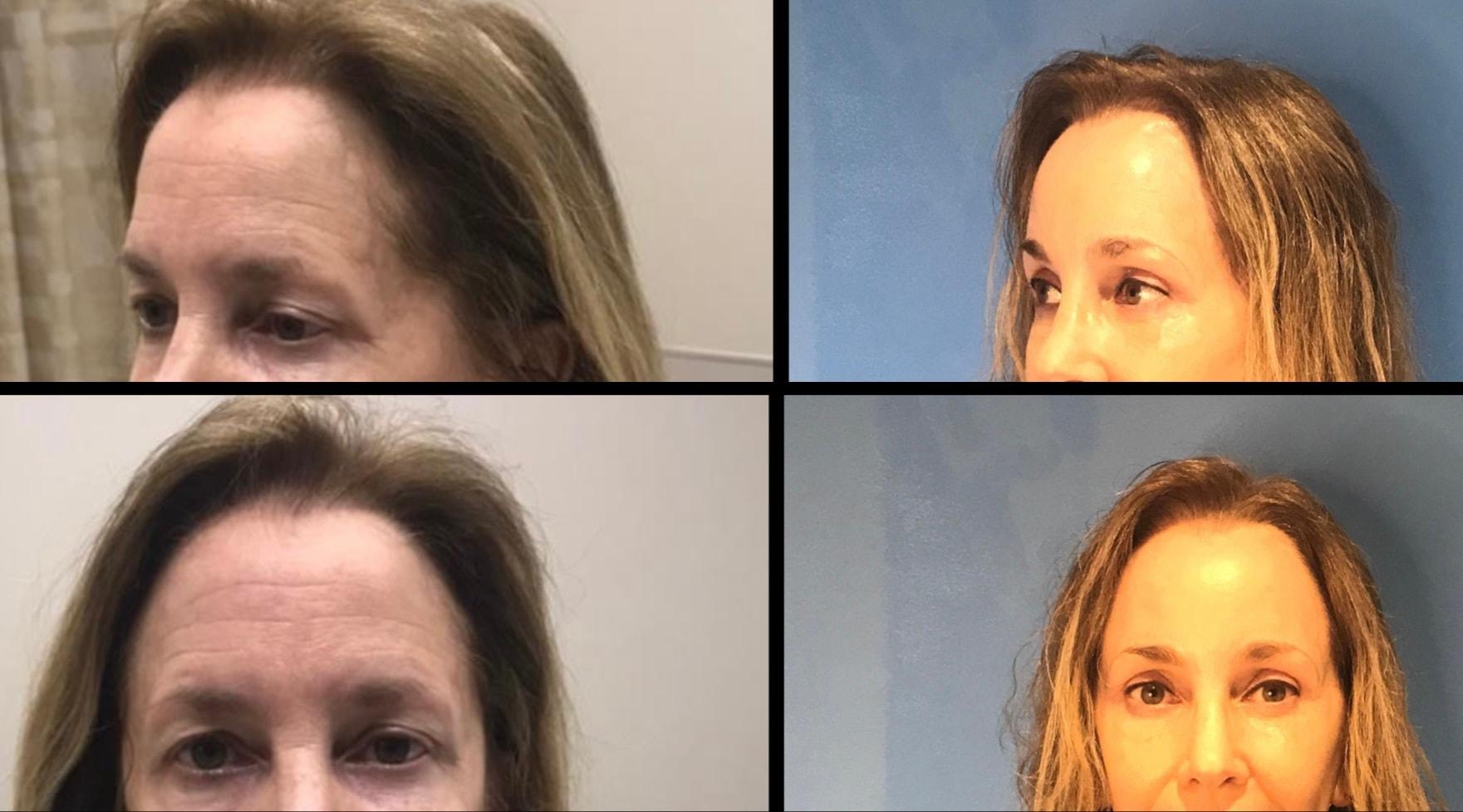 Stanwix Plastic Surgery brow lift result — Richmond, VA