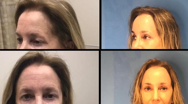 Brow Lift result at Stanwix Plastic Surgery in Richmond, VA