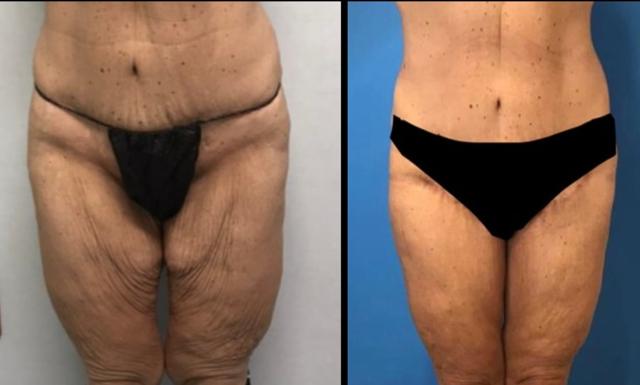CoolSculpting result at Stanwix Plastic Surgery in Richmond, VA
