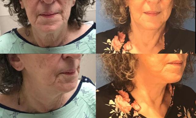 Neck Lift result at Stanwix Plastic Surgery in Richmond, VA
