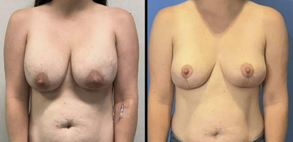 Stanwix Plastic Surgery breast lift result — Henrico, VA