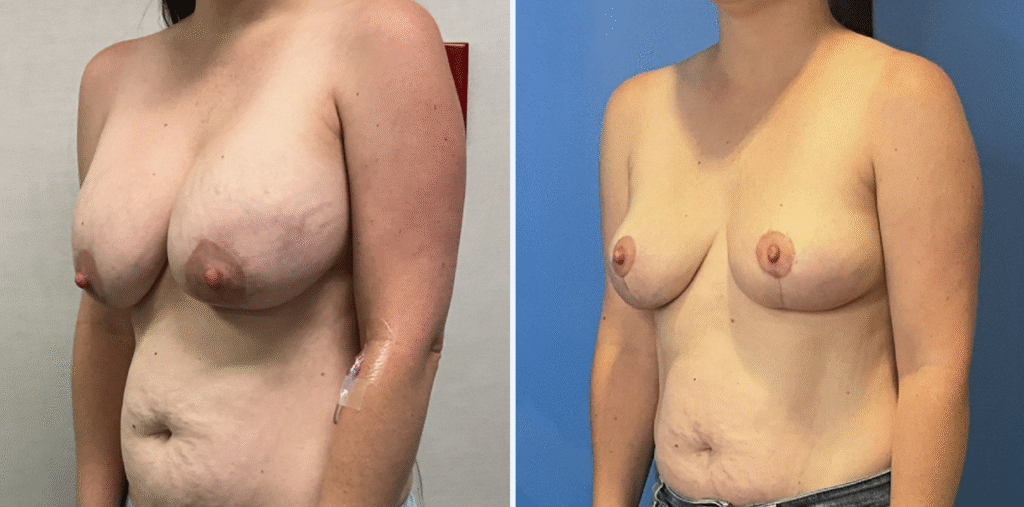 Stanwix Plastic Surgery breast lift result — Henrico, VA