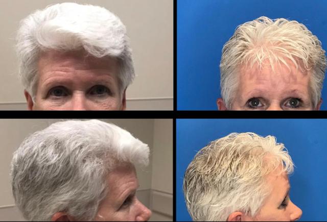 Brow Lift result at Stanwix Plastic Surgery in Richmond, VA