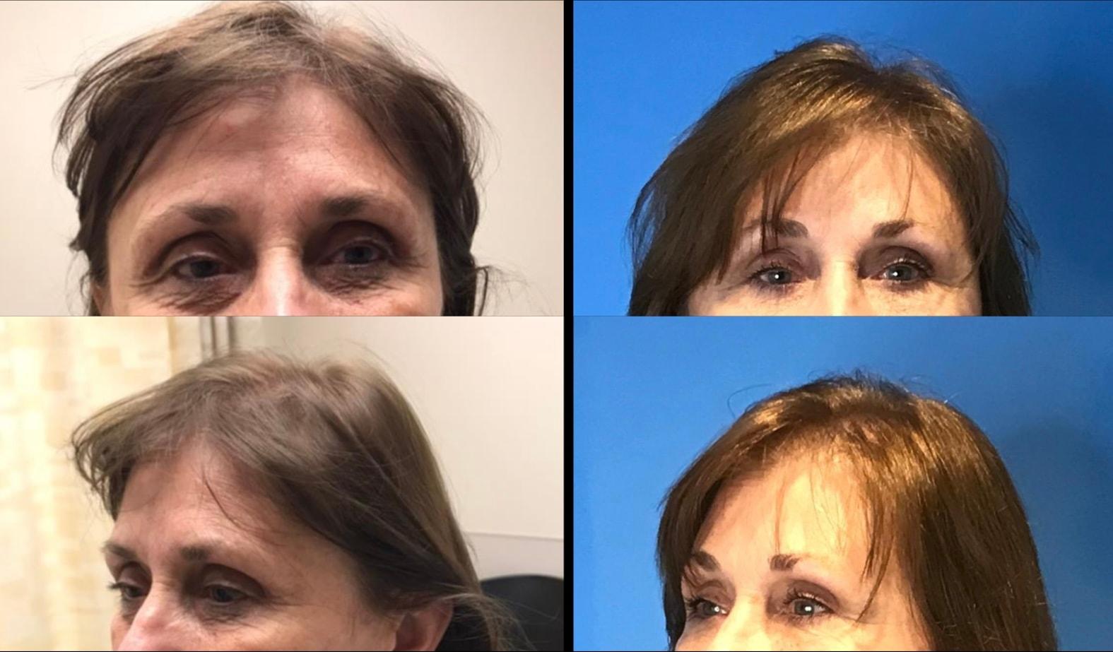 Stanwix Plastic Surgery brow lift result — Richmond, VA