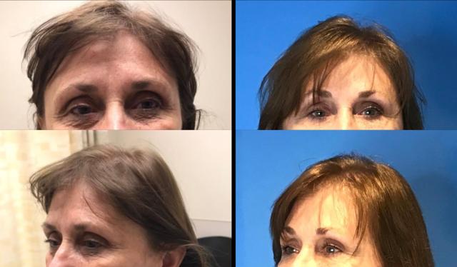 Brow Lift result at Stanwix Plastic Surgery in Richmond, VA
