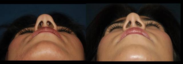 Rhinoplasty result at Stanwix Plastic Surgery in Richmond, VA